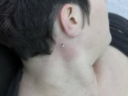 dermal anchor am hals